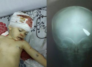 U Halebu preselio dječak koji je pogođen snajperom u glavu (VIDEO)