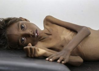 Humanitarne agencije upozoravaju na najgoru glad u Jemenu u 21. stoljeću Glad u Jemenu